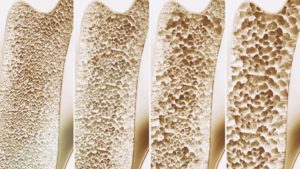 Read more about the article Osteoporosis: Preventing, Stopping, Reversing!